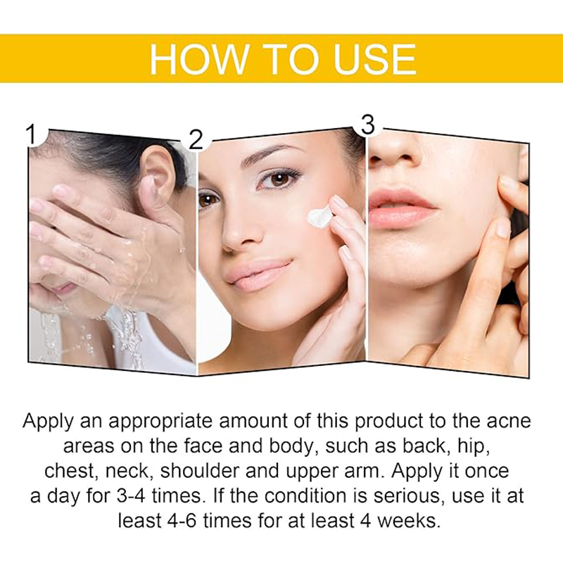 Eelhoe - Cystic Acne Cream (30ML)